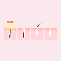 Silhouette Portable Laser Hair Remover Permanent Epliation System Body Face Home Kings Warehouse